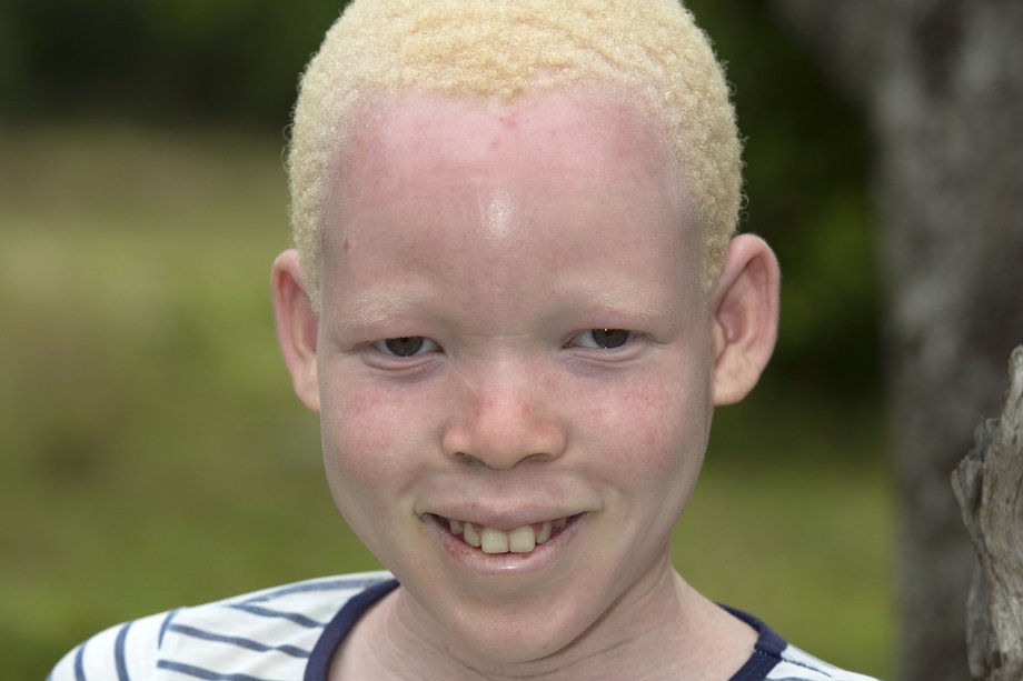 ocular albinism blue eyes