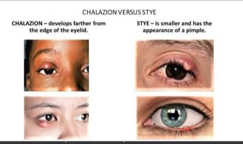 Chalazion deals and stye