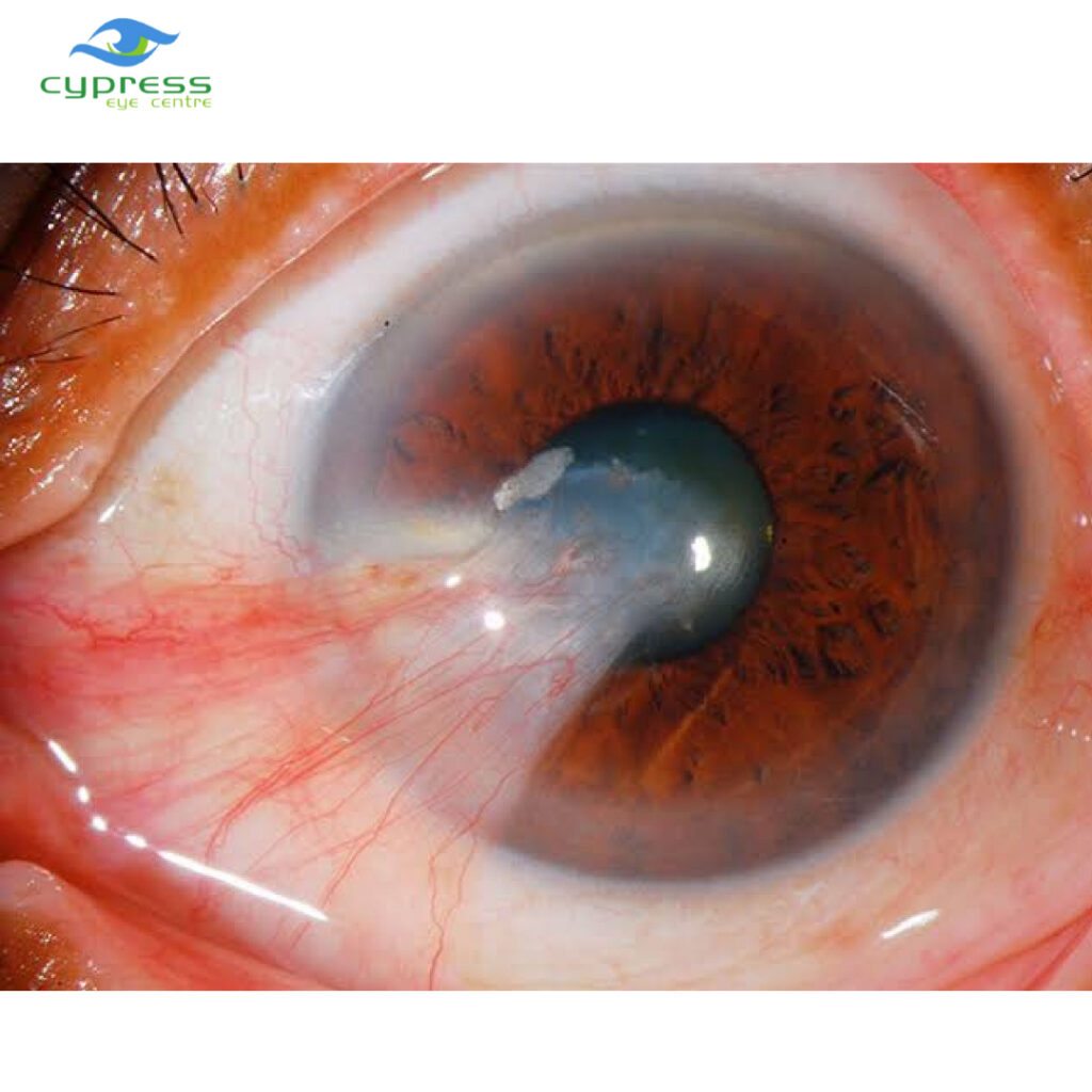 WHAT IS PTERYGIUM? Cypress Eye Centre