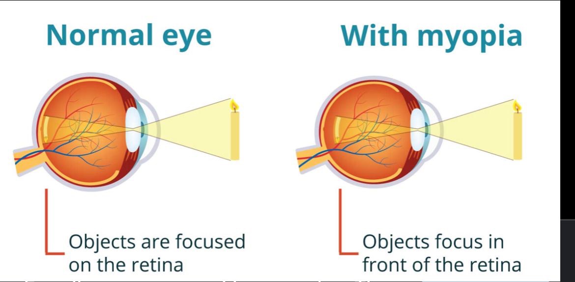 recent research suggests myopia may be caused by