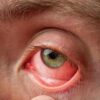 Conjunctivitis