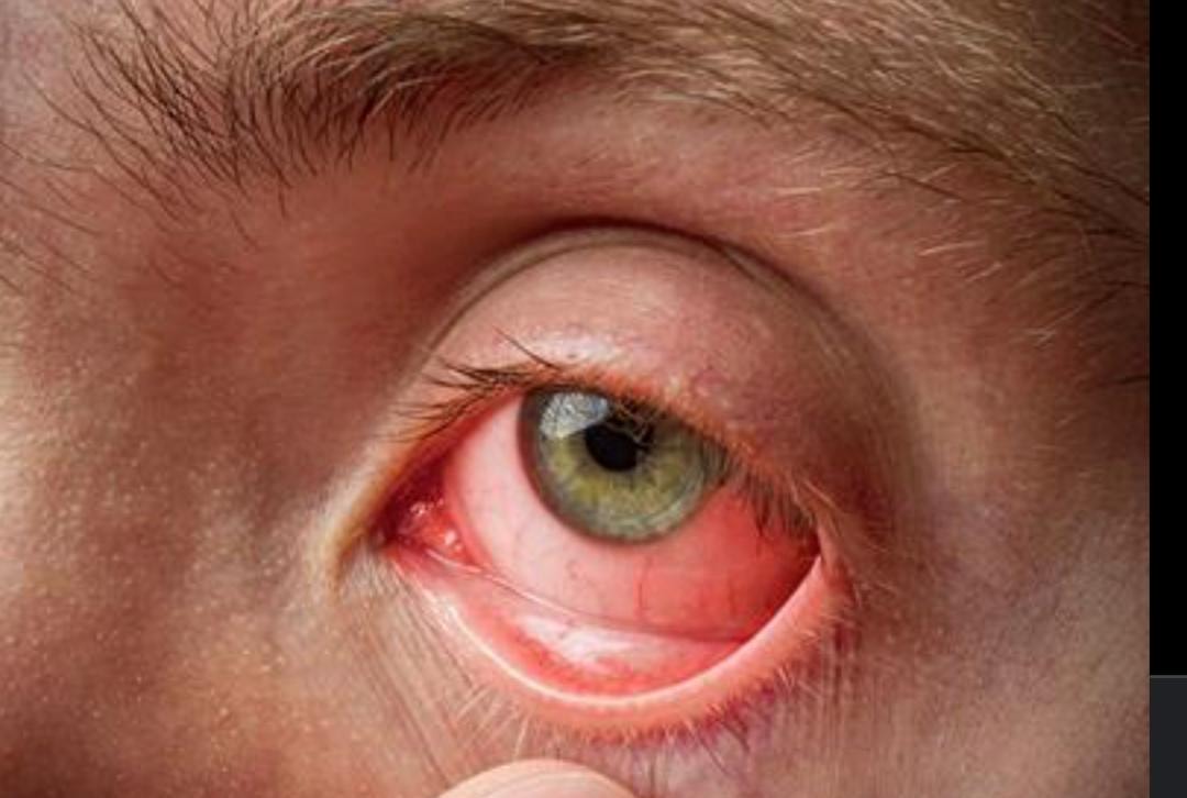 Conjunctivitis