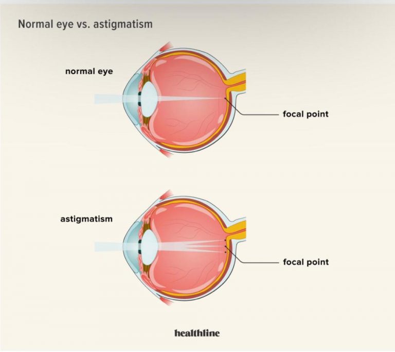 WHAT IS ASTIGMATISM ? – Cypress Eye Centre