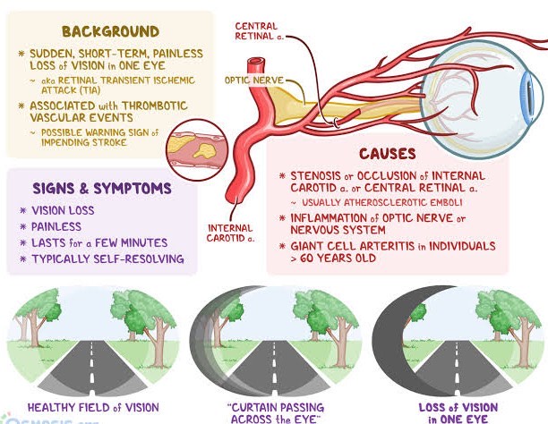 WHAT IS AMAUROSIS FUGAX(AF)