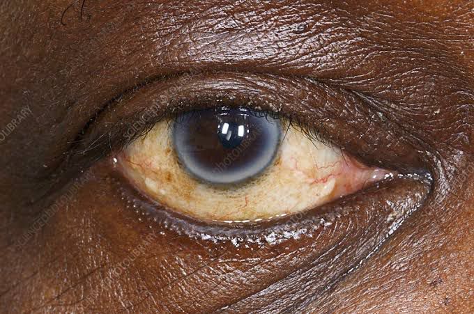 Why Do I Have A Blue Ring around My Eye | TikTok