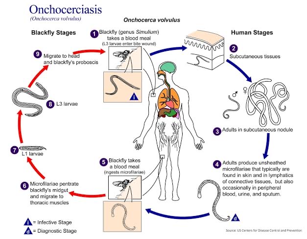 River Blindness